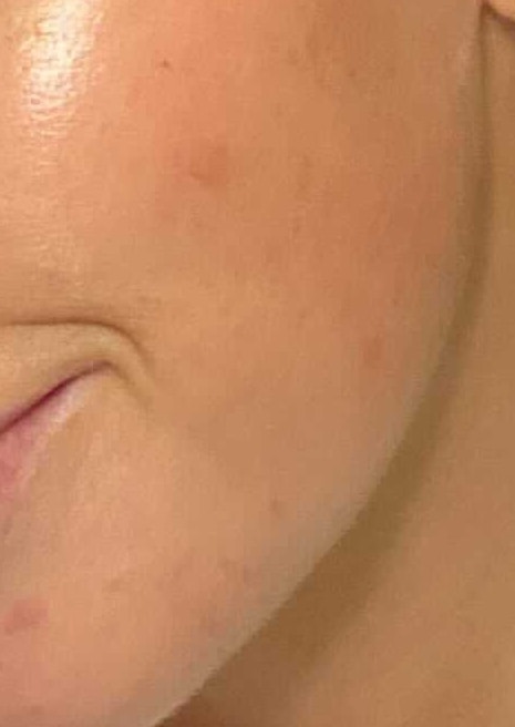 After reduced pores