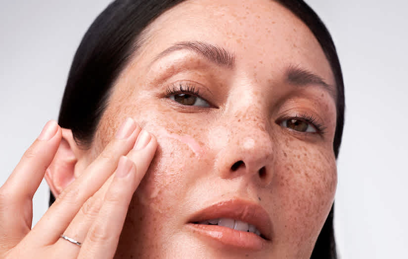 Sebaceous hyperplasia
