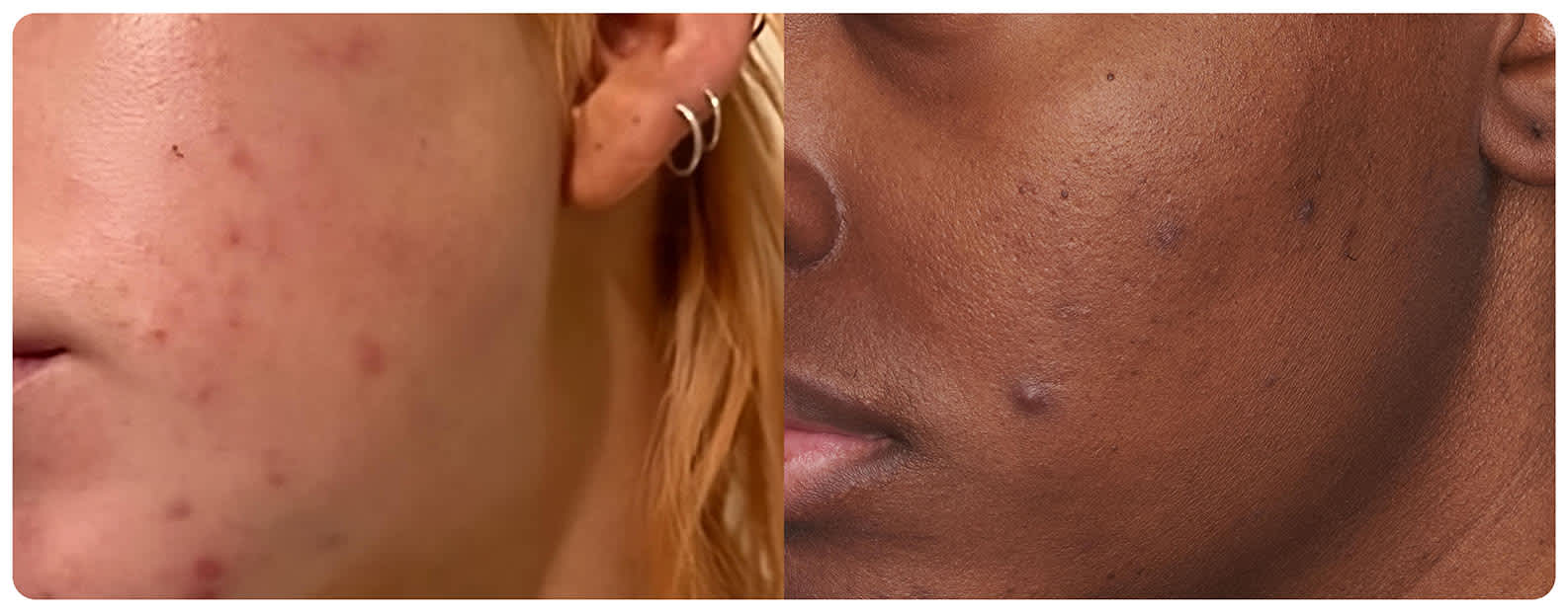 Paula'S Choice Acne Scars: Effective Solutions for Clear Skin