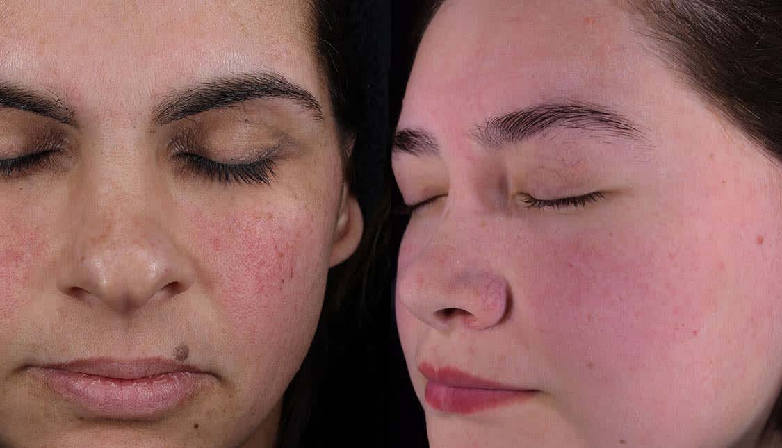 glutathione rosacea Step-by-Step Rosacea Skincare Routine Guide glutathione rosacea Step-by-Step Rosacea Skincare Routine Guide