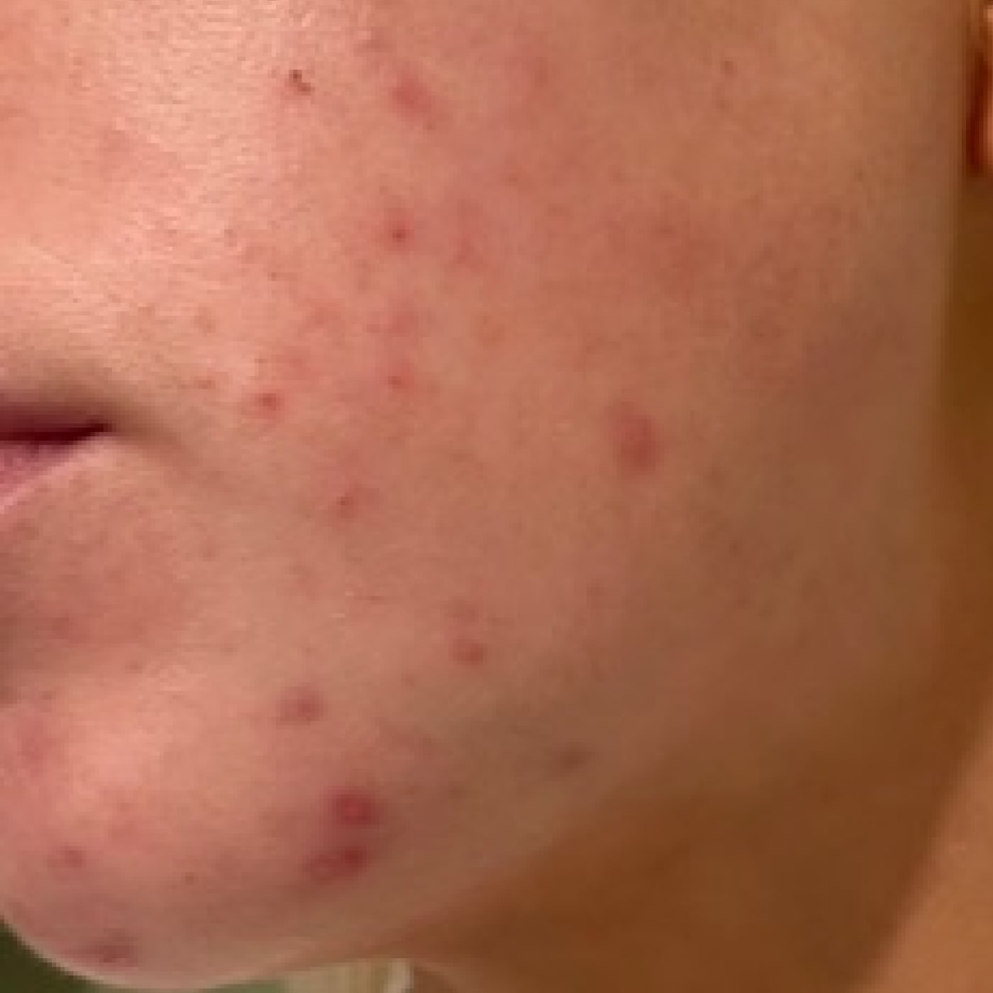 Before using BHA exfoliant