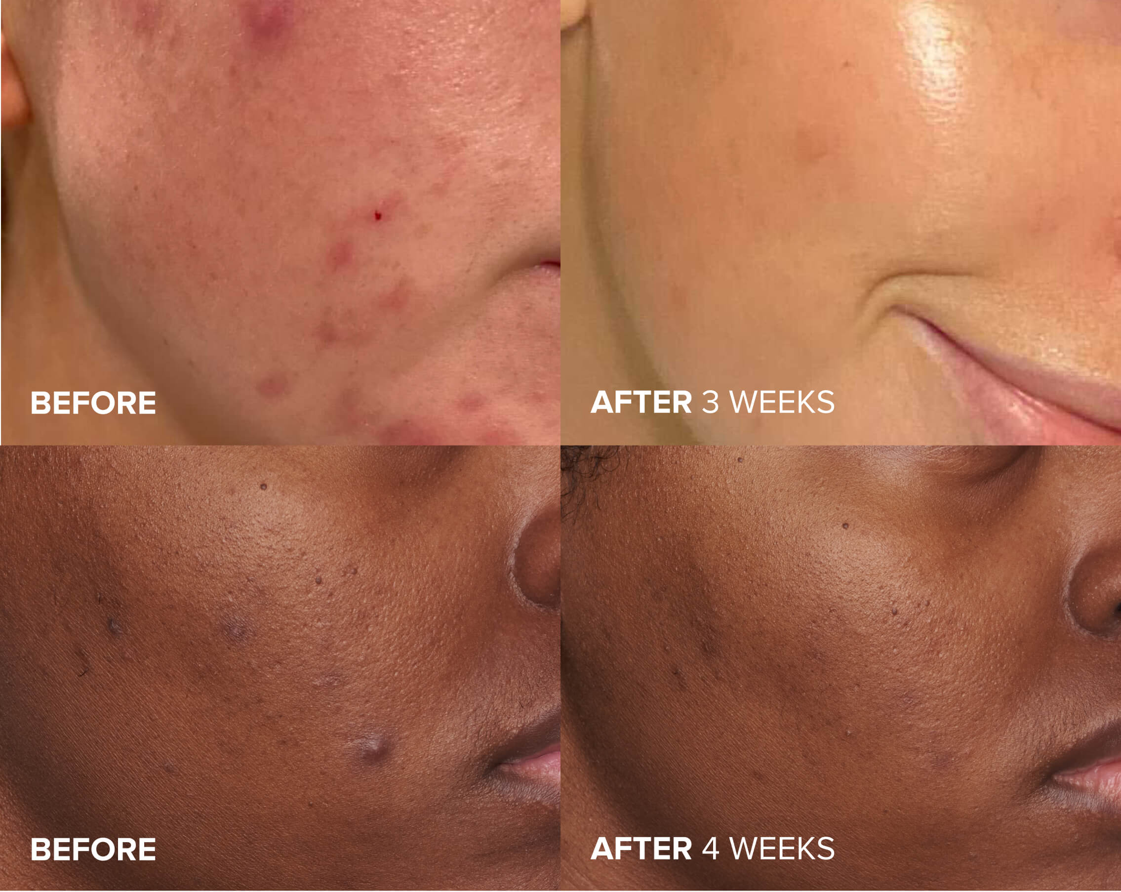 Skin Perfecting 2% Exfoliant before and after