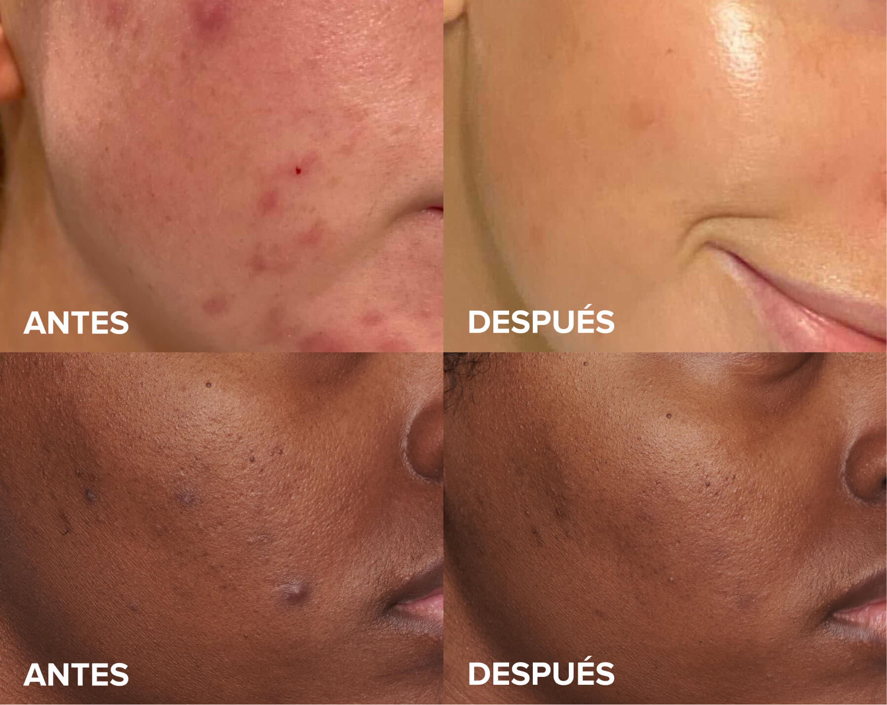 Skin Perfecting 2% Exfoliant before and after