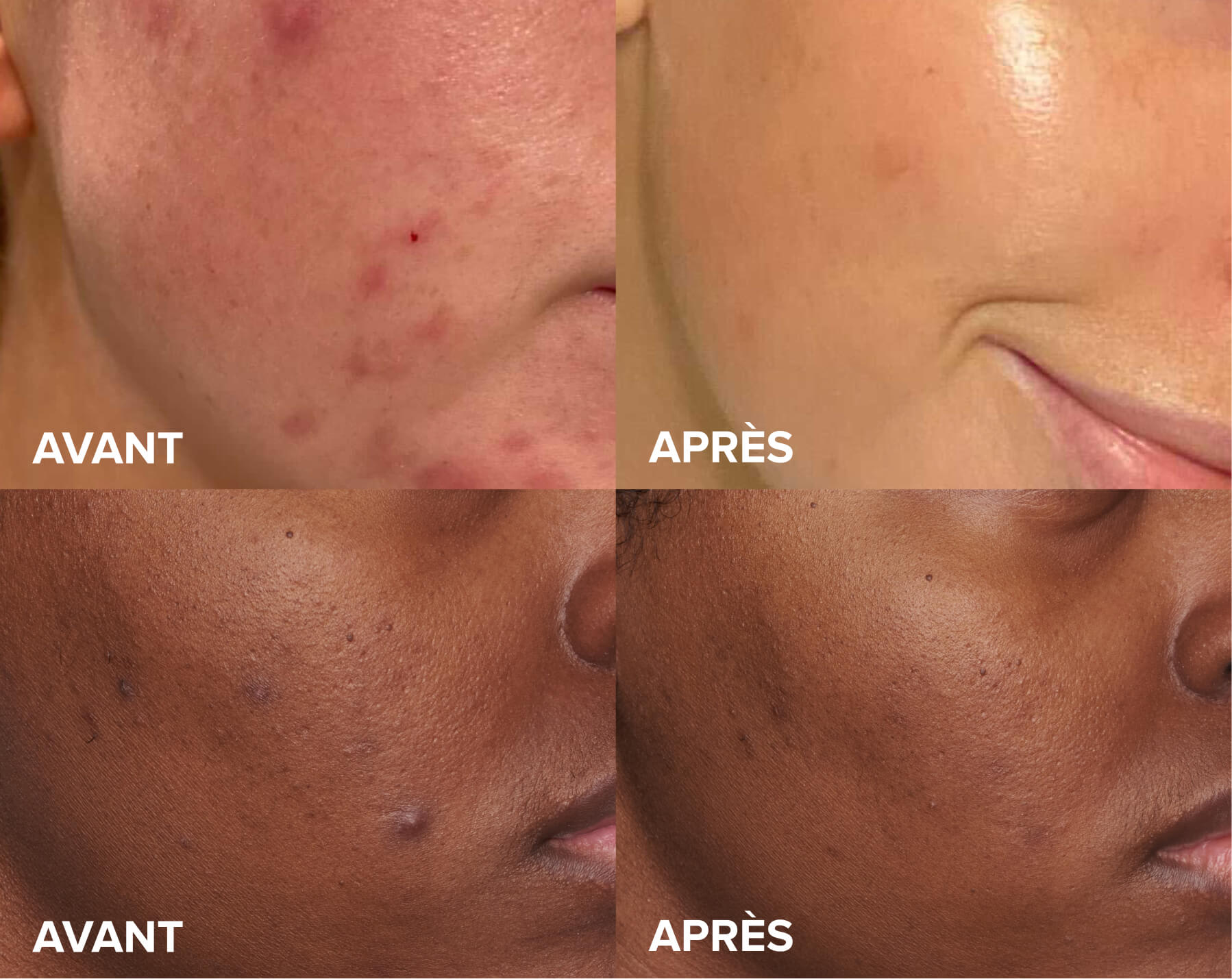 Skin Perfecting 2% Exfoliant before and after