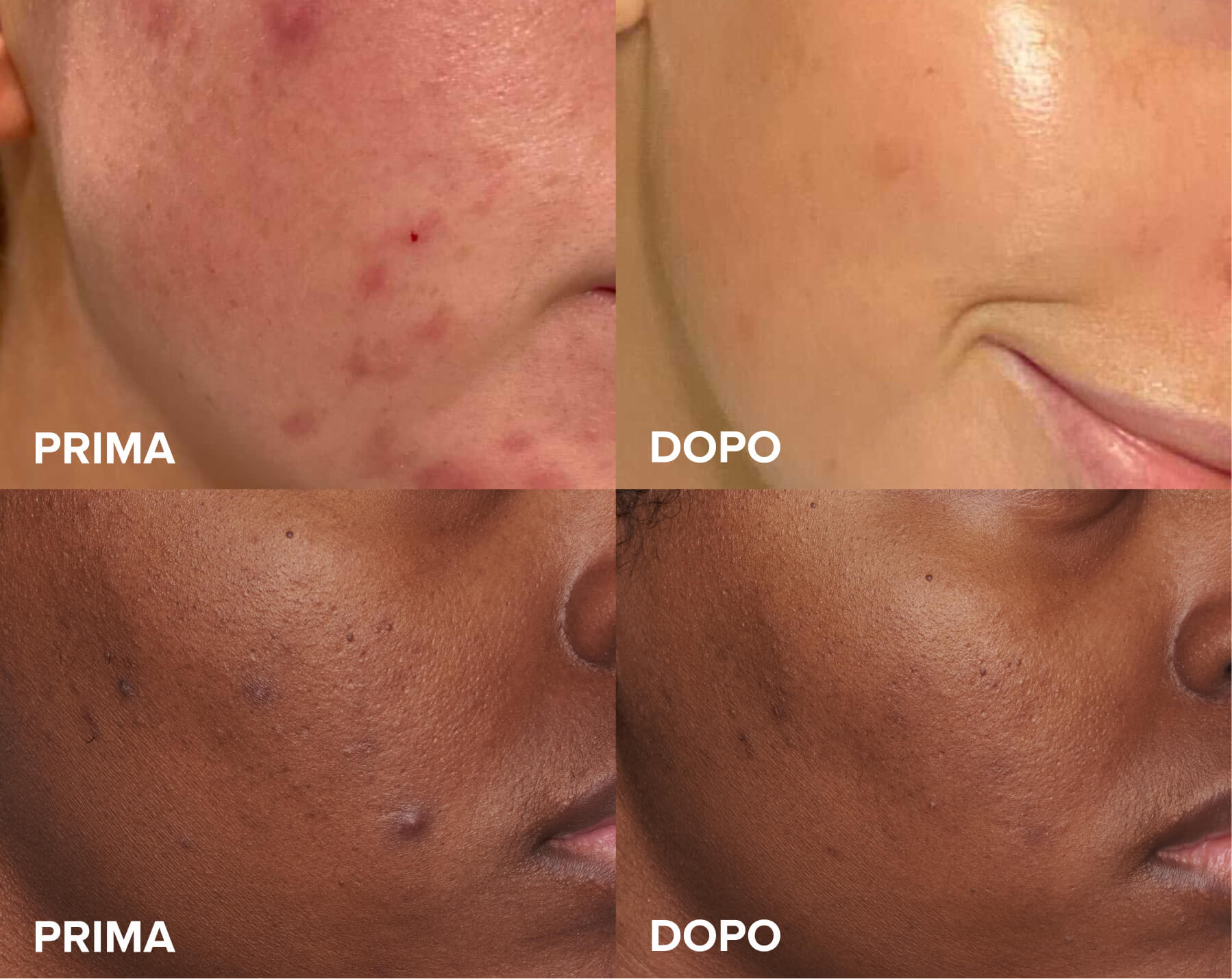 Skin Perfecting 2% Exfoliant before and after