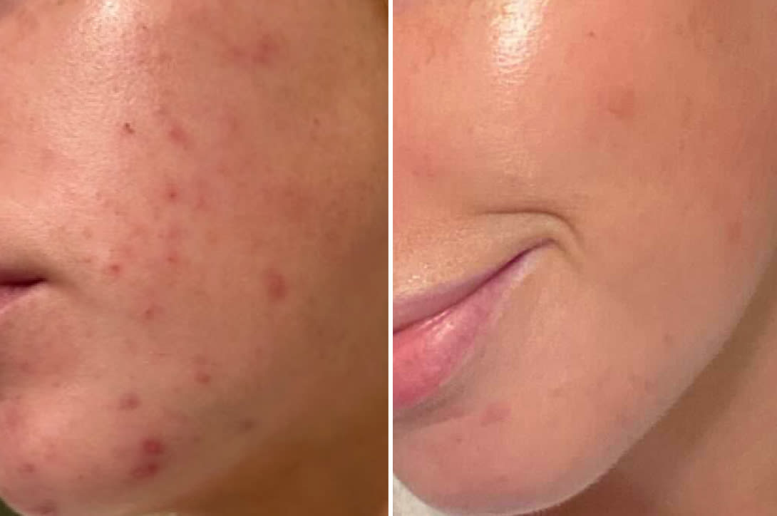 Before and after skin comparison