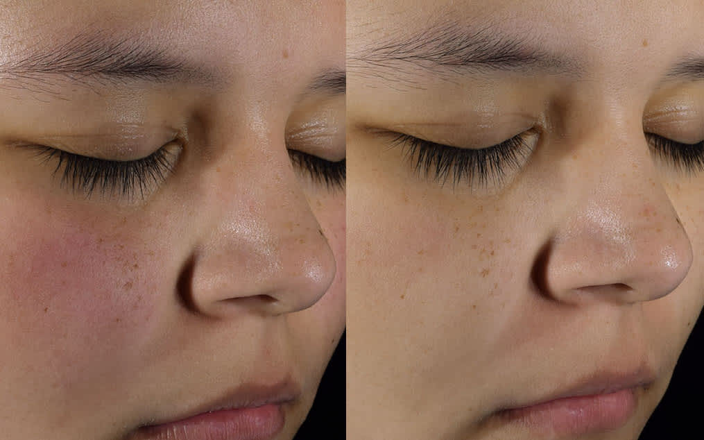 Before improved skin barrier
