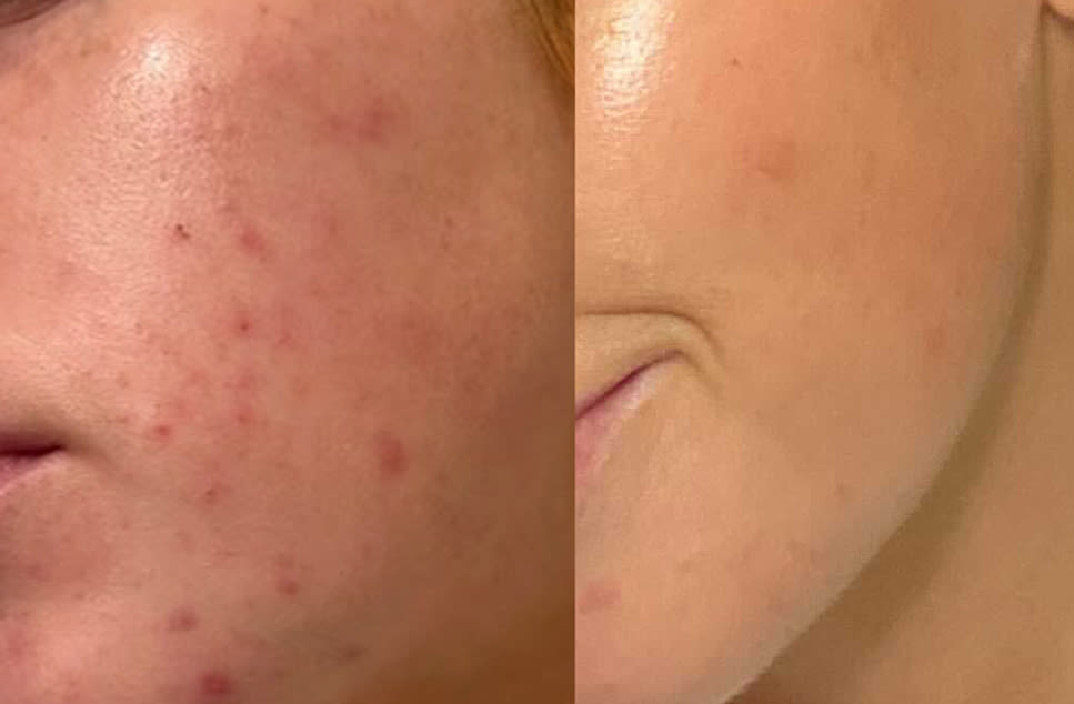 Before reduced pores